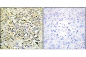 Immunohistochemistry analysis of paraffin-embedded human lung carcinoma tissue, using CDKL4 Antibody. (CDKL4 antibody  (AA 266-315))