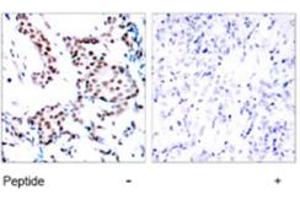 Immunohistochemical analysis of paraffin-embedded human breast carcinoma tissue using JUN polyclonal antibody . (C-JUN antibody)