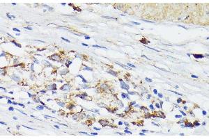 Immunohistochemistry of paraffin-embedded Human gastric cancer using TREM2 Polyclonal Antibody at dilution of 1:200 (40x lens). (TREM2 antibody)