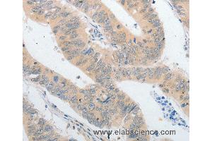 Immunohistochemistry of Human colon cancer using PPAP2A Polyclonal Antibody at dilution of 1:40 (PLPP1 antibody)