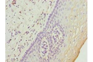 Immunohistochemistry of paraffin-embedded human cervical cancer using ABIN7174639 at dilution of 1:100 (UGT2B10 antibody  (AA 20-280))
