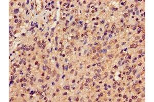 Immunohistochemistry of paraffin-embedded human glioma using ABIN7162945 at dilution of 1:100 (Peroxiredoxin 6 antibody  (AA 87-224))