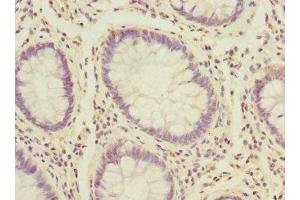 Immunohistochemistry of paraffin-embedded human colon cancer using ABIN7164721 at dilution of 1:100 (PROK2 antibody  (AA 20-129))