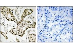 Immunohistochemistry analysis of paraffin-embedded human liver carcinoma tissue, using TOP2A Antibody. (Topoisomerase II alpha antibody  (AA 1-50))