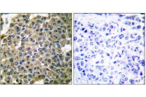 Immunohistochemical analysis of paraffin-embedded human breast carcinoma tissue using Keratin 7 antibody (ABIN5976442). (Cytokeratin 7 antibody  (C-Term))