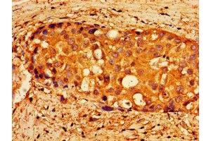 Immunohistochemistry of paraffin-embedded human breast cancer using ABIN7161394 at dilution of 1:100 (NPX1 antibody  (AA 88-227))