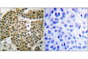 Immunohistochemistry analysis of paraffin-embedded human breast carcinoma tissue, using NF-kappaB p105/p50 (Ab-927) Antibody. (NFKB1 antibody  (AA 896-945))