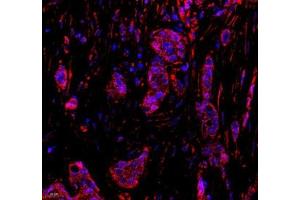 Immunofluorescence of paraffin embedded human breast cancer using DDX19B (ABIN7073694) at dilution of 1: 650 (400x lens) (DDX19B antibody)