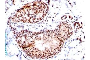 Formalin-fixed, paraffin-embedded human Breast Carcinoma stained with SUMO-1 Mouse Monoclonal Antibody (SM1/495) (SUMO1 antibody)