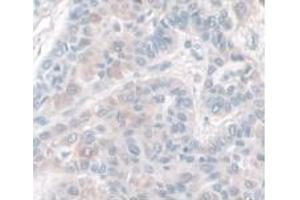 DAB staining on IHC-P; Samples: Human Liver Cancer Tissue.