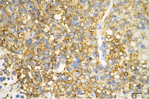 Immunohistochemistry was performed on paraffin-embedded human glioblastoma using creatine kinase B antibody (ABIN7798163), 1:200).