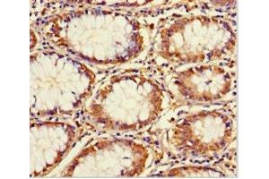 Immunohistochemistry of paraffin-embedded human colon cancer using ABIN7172166 at dilution of 1:100 (CCDC59 antibody  (AA 1-241))