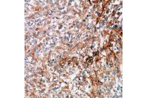 Immunohistochemical analysis of GRP78 staining in human breast cancer formalin fixed paraffin embedded tissue section. (GRP78 antibody  (C-Term))