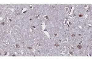 ABIN6268712 at 1/100 staining Human brain cancer tissue by IHC-P. (Aquaporin 4 antibody  (Internal Region))
