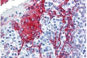 Human Tonsil (formalin-fixed, paraffin-embedded) stained with KRT13 antibody ABIN364278 at 10 ug/ml followed by biotinylated anti-mouse IgG secondary antibody ABIN481714, alkaline phosphatase-streptavidin and chromogen. (Cytokeratin 13 antibody)