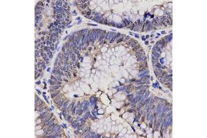 Immunohistochemistry of paraffin-embedded human rectal cancer using NPPA antibody (ABIN5970781) at dilution of 1/200 (40x lens).