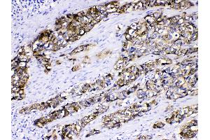 Cytokeratin 5 was detected in paraffin-embedded sections of human oesophagus squama cancer tissues using rabbit anti- Cytokeratin 5 Antigen Affinity purified polyclonal antibody (Catalog # ) at 1 µg/mL. (Cytokeratin 5 antibody  (Middle Region))