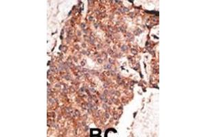 Formalin-fixed and paraffin-embedded human cancer tissue reacted with the primary antibody, which was peroxidase-conjugated to the secondary antibody, followed by AEC staining. (BMP1 antibody  (C-Term))