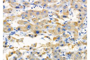 ABIN6257437 and ABIN6275374 at 1/100 staining Human liver cancer by IHC-P. (KCNK4 antibody  (C-Term))
