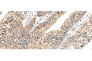 Immunohistochemistry of paraffin-embedded Human gastric cancer tissue using CA7 Polyclonal Antibody at dilution of 1:50(x200) (CA7 antibody)
