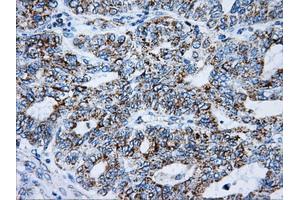 Immunohistochemical staining of paraffin-embedded Adenocarcinoma of breast tissue using anti-ATP5B mouse monoclonal antibody. (ATP5B antibody)