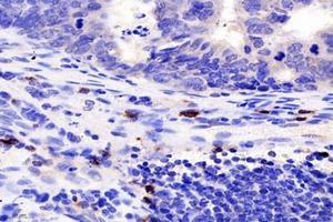 Immunohistochemistry analysis of paraffin-embedded human colon cancer using TCRb (ABIN7075813) at dilution of 1: 1800 (TCRb antibody)