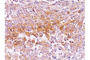 Formalin-fixed, paraffin-embedded human melanoma stained with gp100 / Melanosome Mouse Monoclonal Antibody (NKI-beteb).