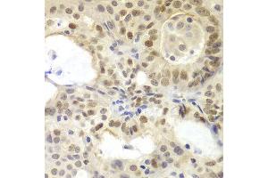 Immunohistochemistry of paraffin-embedded human oophoroma using MSH6 antibody at dilution of 1:100 (400x lens). (MSH6 antibody)