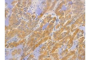 ABIN6255365 and ABIN6267475 at 1/100 staining human lung adenocarcinoma by IHC-P.