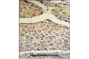 BF Antibody (Center) (R) IHC analysis in formalin fixed and paraffin embedded human hepatocarcinoma tissue followed by peroxidase conjugation of the secondary antibody and DAB staining. (Complement Factor B antibody  (Center))