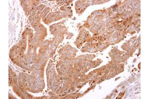 IHC-P Image ARF3 antibody detects ARF3 protein at cytosol on human colon carcinoma by immunohistochemical analysis. (ARF3 antibody)