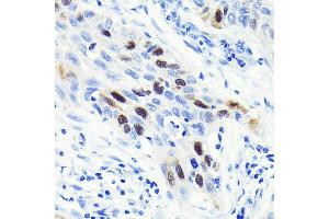 Immunohistochemistry of paraffin-embedded human lung cancer using Cyclin  Rabbit mAb (ABIN7266551) at dilution of 1:100 (40x lens). (Cyclin A antibody)