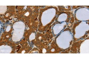 Immunohistochemistry of paraffin-embedded Human thyroid cancer using RAB27A Polyclonal Antibody at dilution of 1:30 (RAB27A antibody)