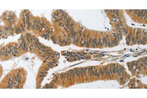 Immunohistochemistry of paraffin-embedded Human colon cancer tissue using PIK3R3 Polyclonal Antibody at dilution 1:45 (PIK3R3 antibody)