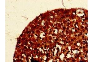 Immunohistochemistry of paraffin-embedded human breast cancer using ABIN7154360 at dilution of 1:100 (PIGK antibody  (AA 91-293))