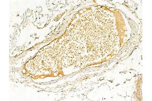 ABIN6256503 and ABIN6267060 at 1/100 staining Human normal tissues adjacent to colorectal cancer by IHC-P.