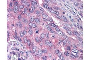 Anti-PLK1 antibody IHC of human lung carcinoma. (PLK1 antibody  (pThr210))