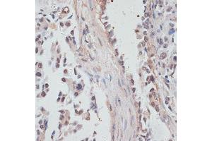 Immunohistochemistry of paraffin-embedded human lung cancer using NCO antibody  at dilution of 1:100 (40x lens). (NCOA4 antibody  (AA 495-614))