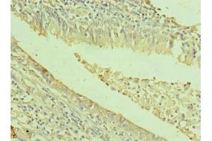 Immunohistochemistry of paraffin-embedded human lung cancer using ABIN7171996 at dilution of 1:100 (TXNDC11 antibody  (AA 656-985))