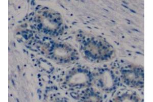 Detection of MMP9 in Human Breast cancer Tissue using Monoclonal Antibody to Matrix Metalloproteinase 9 (MMP9) (MMP 9 antibody  (AA 213-399))
