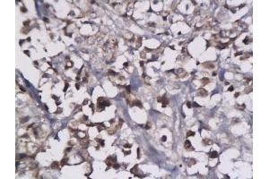Formalin-fixed and paraffin embedded human breast cancer tissue labeled with Anti-LYVE-1 Polyclonal Antibody, Unconjugated (ABIN674799) followed by conjugation to the secondary antibody and DAB staining (LYVE1 antibody  (AA 231-318))