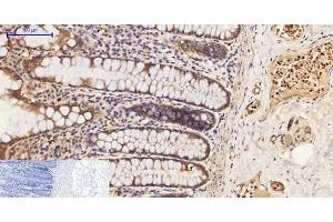 Immunohistochemistry of paraffin-embedded Human colon tissue using Phospho-PI 3 kinase p85 alpha /gamma (Tyr467/199) Polyclonal Antibody at dilution of 1:200 (PI3K p85 alpha/gamma antibody  (pTyr199, pTyr467))