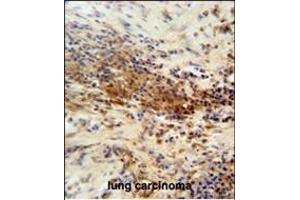 DNAJC11 antibody (N-term) (ABIN654437 and ABIN2844172) immunohistochemistry analysis in formalin fixed and paraffin embedded human lung carcinoma followed by peroxidase conjugation of the secondary antibody and DAB staining. (DNAJC11 antibody  (N-Term))