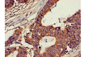Immunohistochemistry of paraffin-embedded human colon cancer using ABIN7147600 at dilution of 1:100 (CH25H antibody  (AA 142-272))