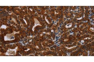 Immunohistochemistry of paraffin-embedded Human thyroid cancer tissue using KLHL1 Polyclonal Antibody at dilution 1:30 (KLHL1 antibody)