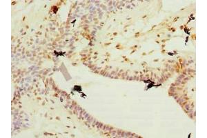 Immunohistochemistry of paraffin-embedded human breast cancer using ABIN7177750 at dilution of 1:100 (Plet1 antibody  (AA 28-218))
