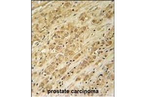 DKC1 Antibody (Center) (ABIN651670 and ABIN2840353) immunohistochemistry analysis in formalin fixed and paraffin embedded human prostate carcinoma followed by peroxidase conjugation of the secondary antibody and DAB staining. (DKC1 antibody  (AA 185-213))