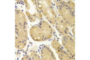 Immunohistochemistry of paraffin-embedded Human gastric using AKT1 antibody at dilution of 1:100 (x400 lens).