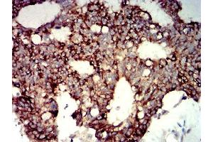 Immunohistochemical analysis of paraffin-embedded colon cancer tissues using P2RY14 mouse mAb with DAB staining. (P2RY14 antibody)