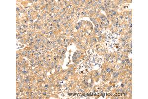 Immunohistochemistry of Human breast cancer using S100A12 Polyclonal Antibody at dilution of 1:45 (S100A12 antibody)